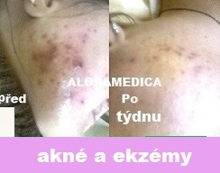 akné a ekzém