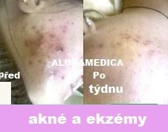 Ošetření Akné a podrážděná pleť